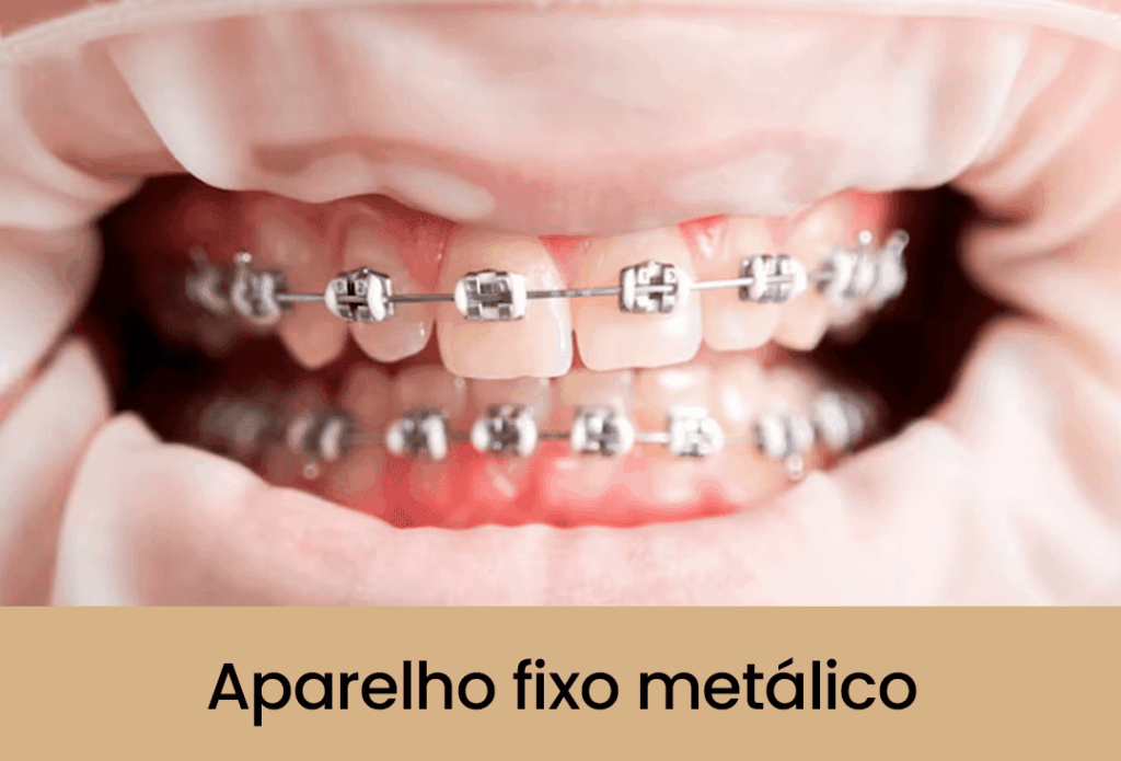 Aparelho fixo metálico