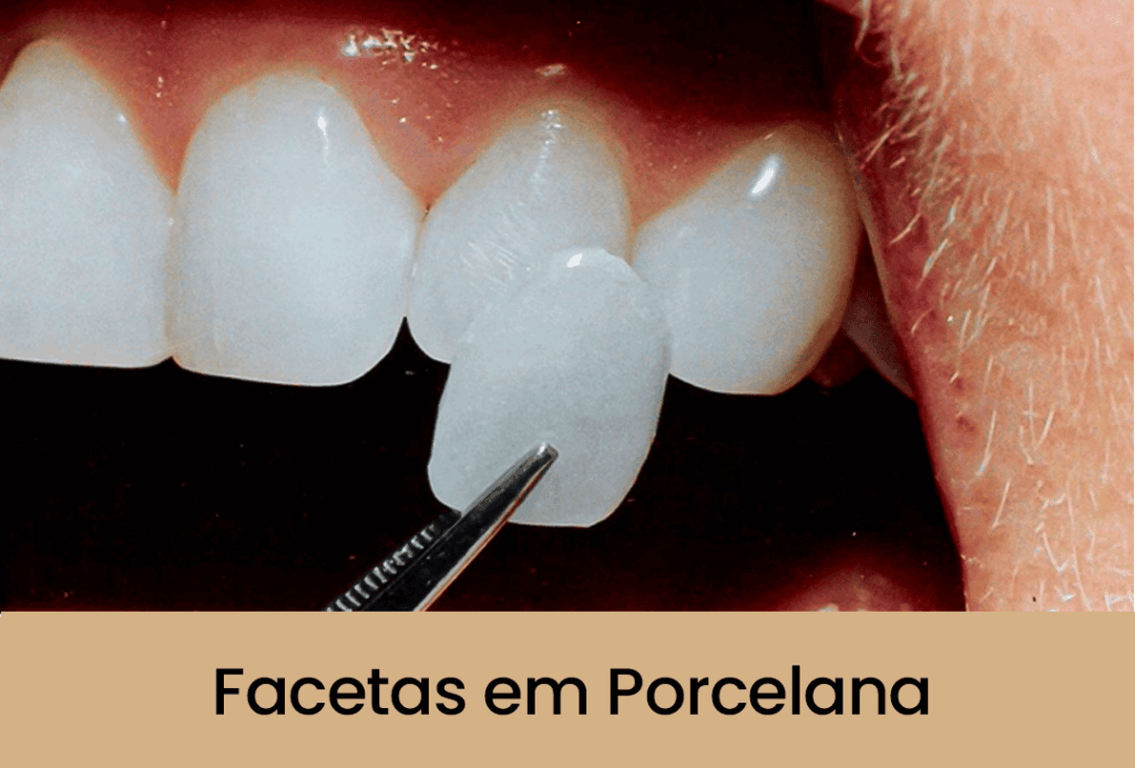 Facetas em Porcelana