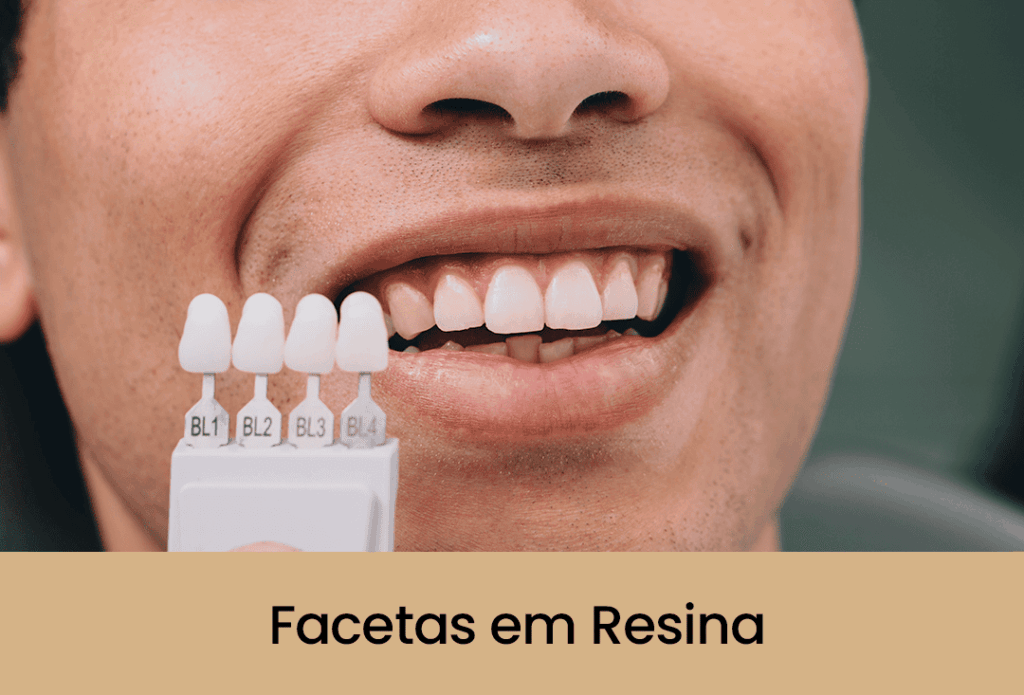 Facetas em Resina