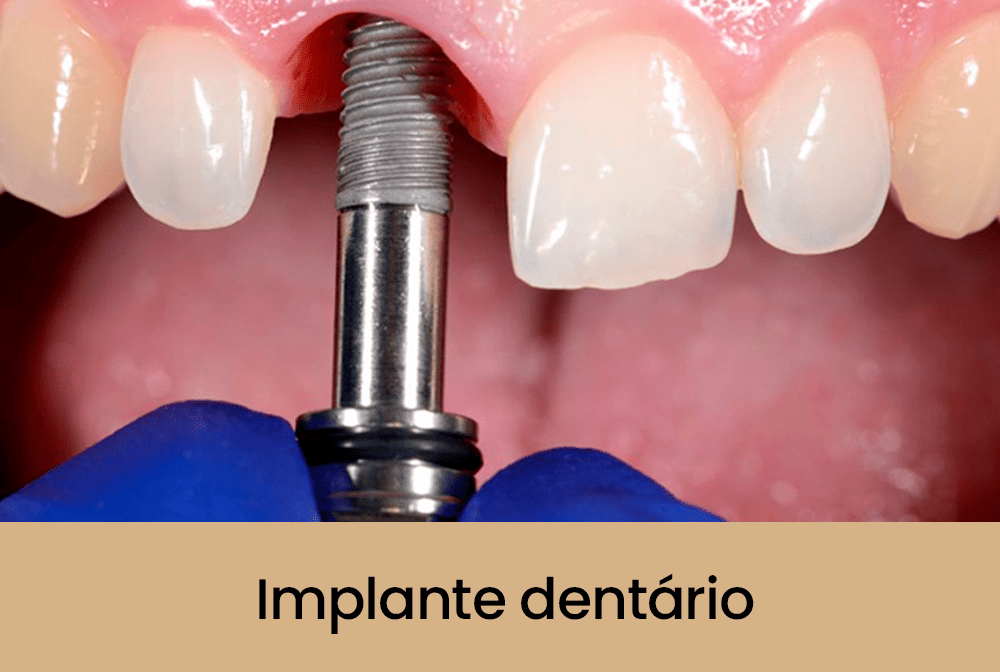 Implante Dentário